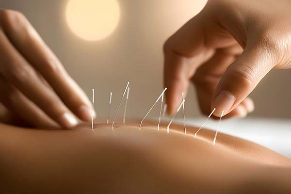 置鍼治療のイメージ画像