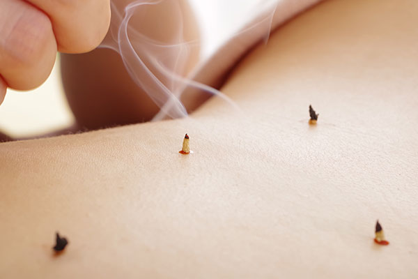 鍼灸治療のイメージ画像